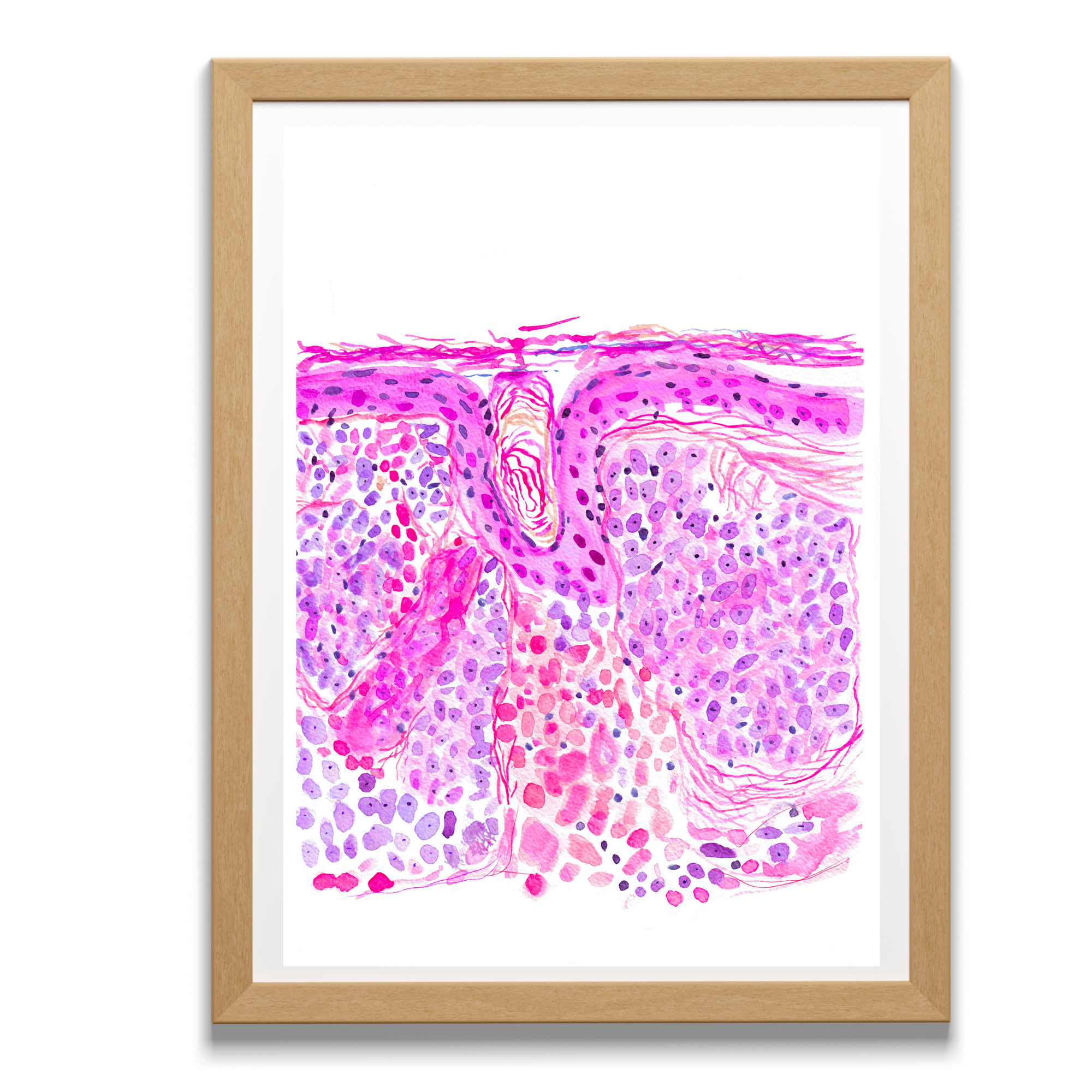 basal cell carinoma skin art print
