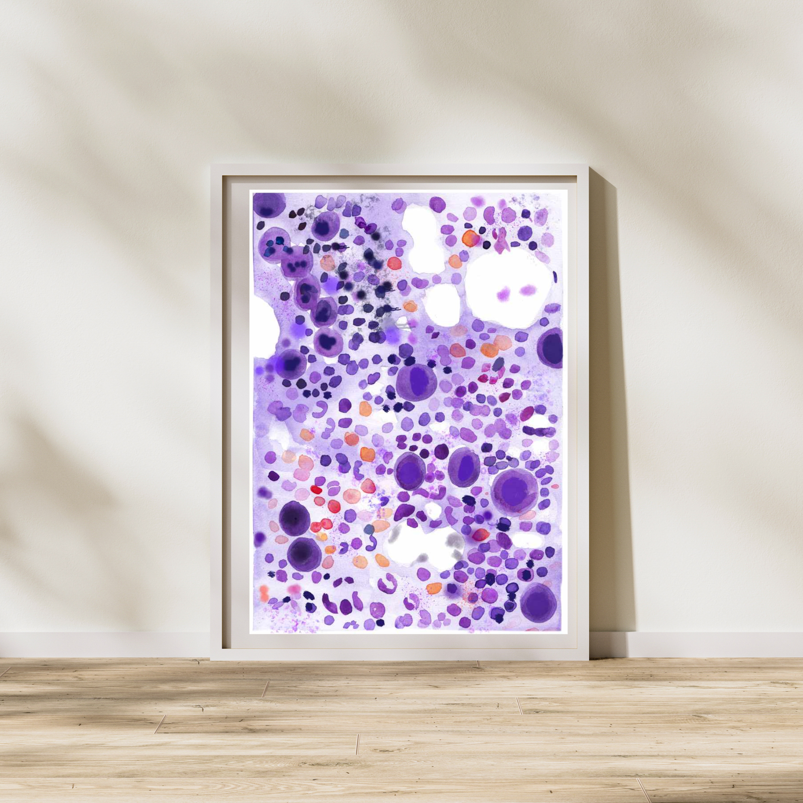 ITP - Idiopathic Thrombocytopenia Bone Marrow Aspirate