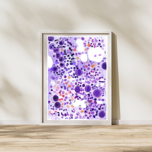 ITP - Idiopathic Thrombocytopenia Bone Marrow Aspirate