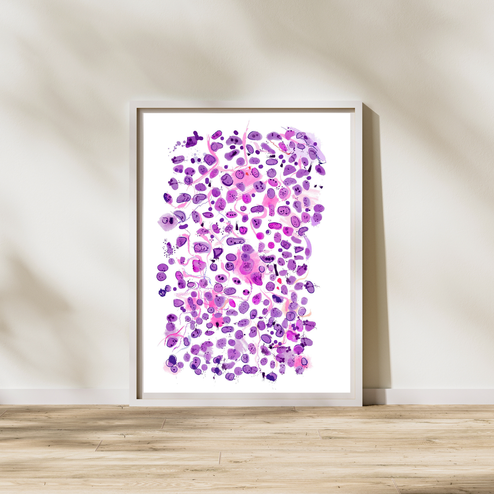 Anaplastic Large Cell Lymphoma Print, Abstract Pathology Art