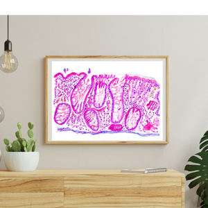 Crohn´s Disease Histopathology Art Print