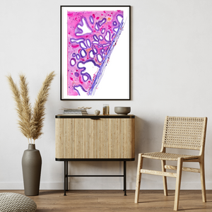 Cervical Cancer Histopathology, Uterine Histology Art, OBGYN Art, Gynecology Art, Gynecologist Gift, Pathology Art, Pathologist Gift