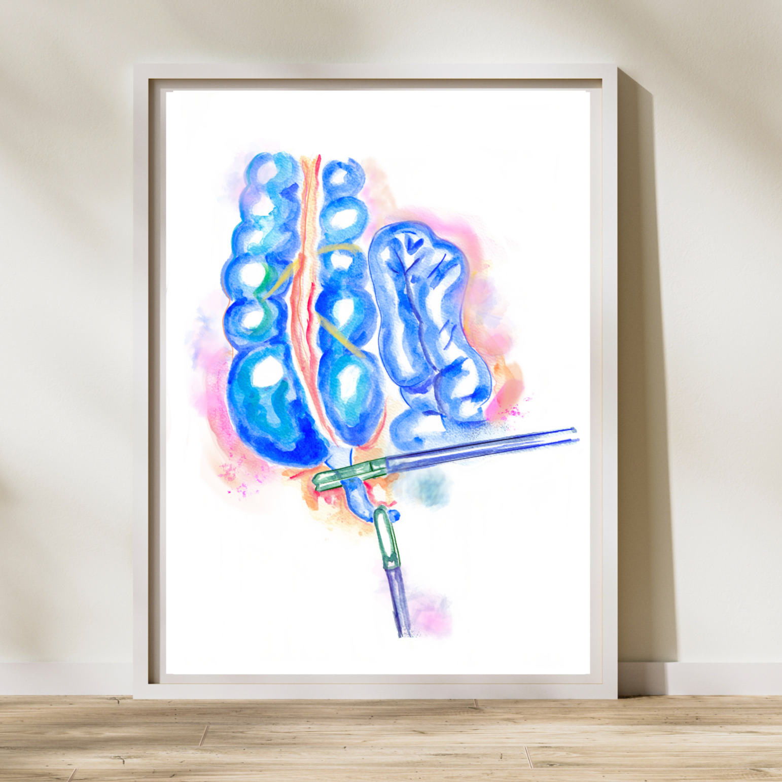 general surgery appendectomy art print