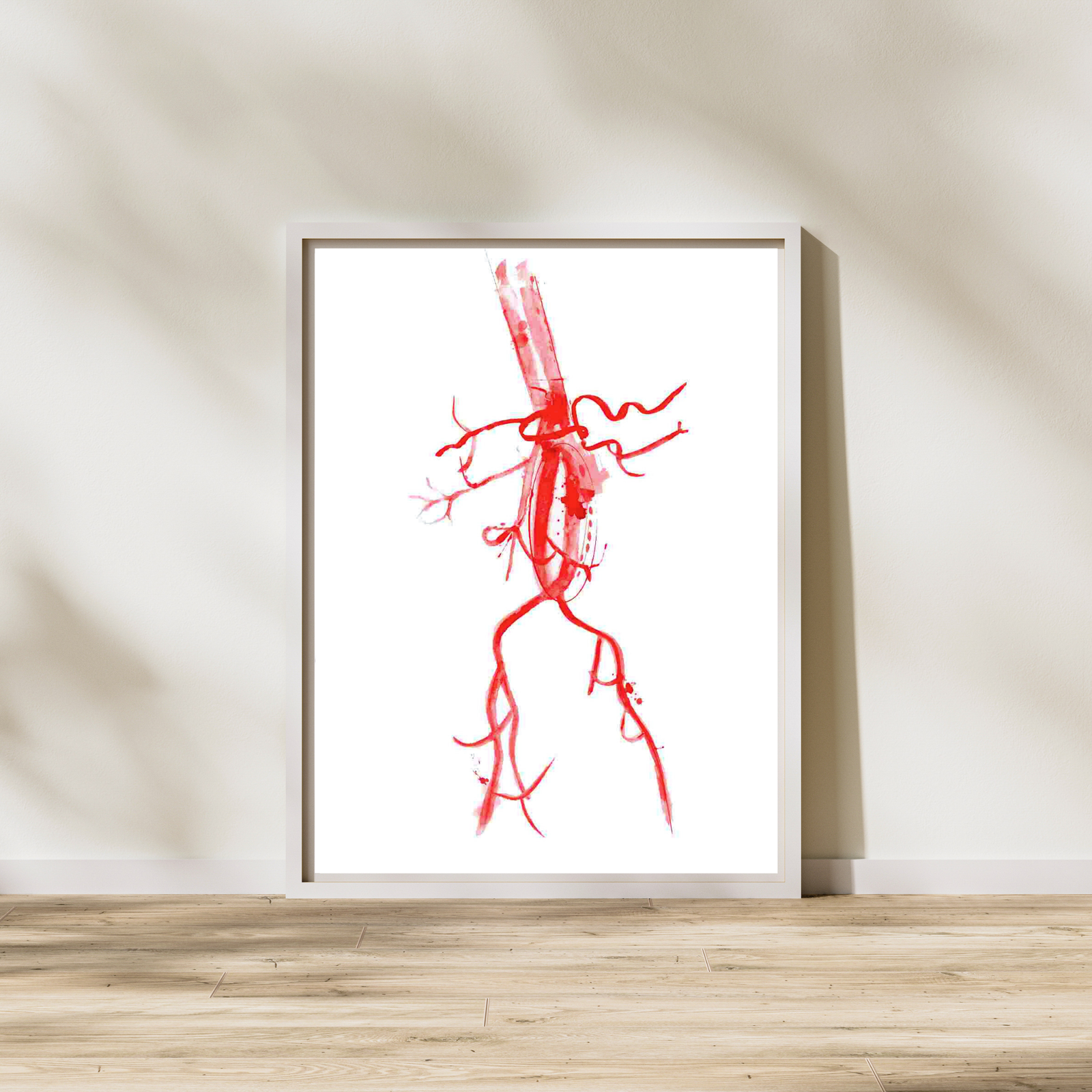 Abdominal Aorta Aneurysm