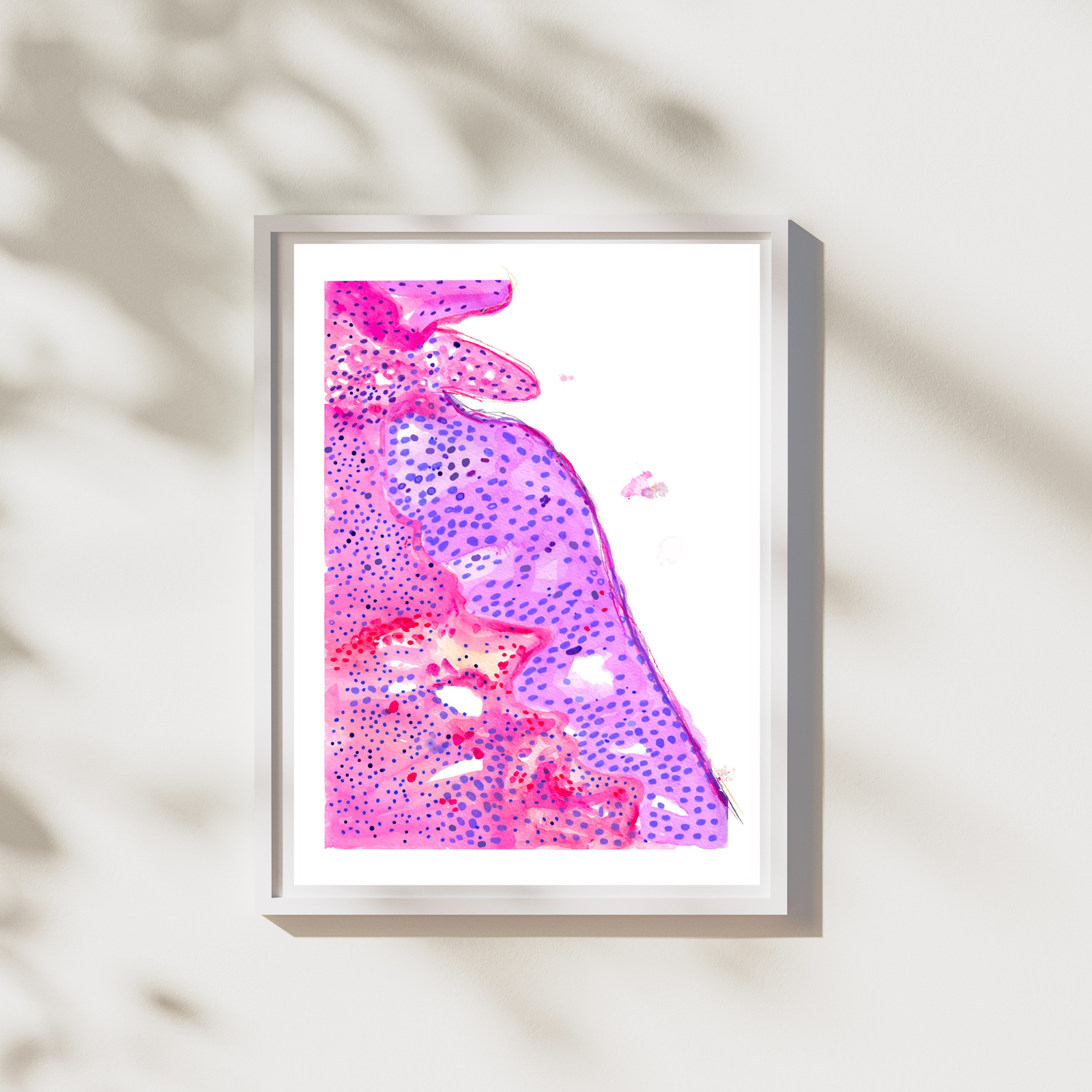 oral squamous cell carcinoma watercolor painting