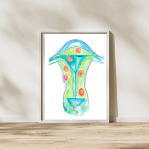 Uterine Fibroids Art Print for OBGYN Offices