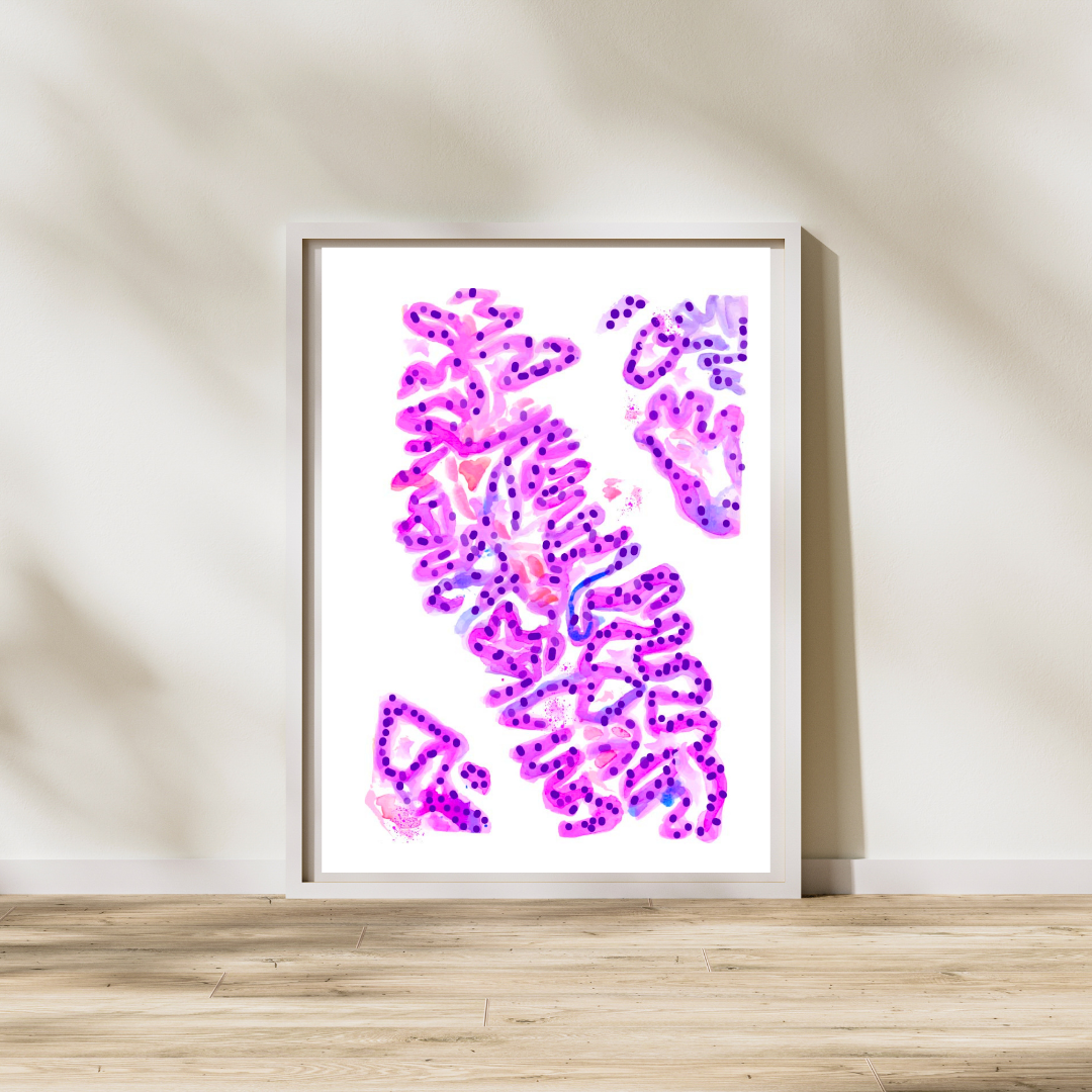 Urothelial Carcinoma Pathology Art