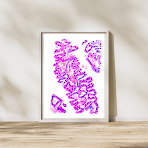 Urothelial Carcinoma Pathology Art