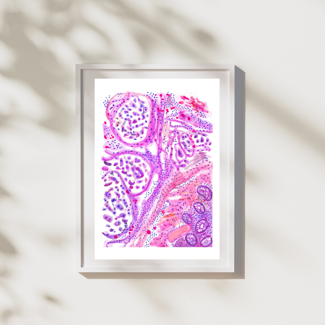 colon adenocarcinoma histopathology painting