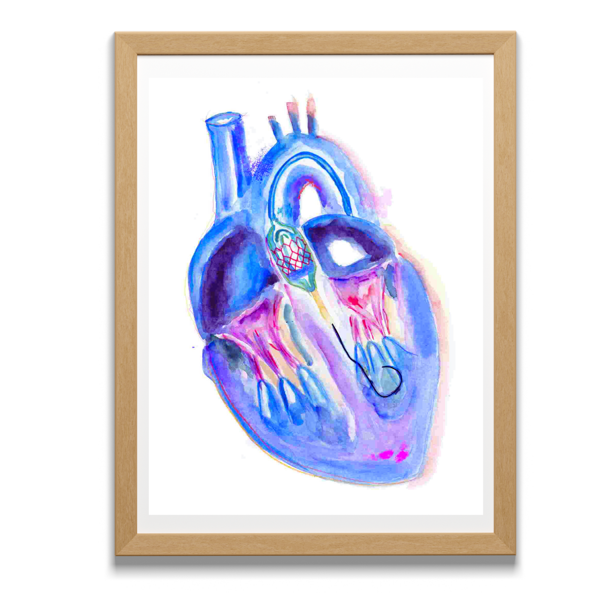 Transaortic Valve Replacement Watercolor Art Print