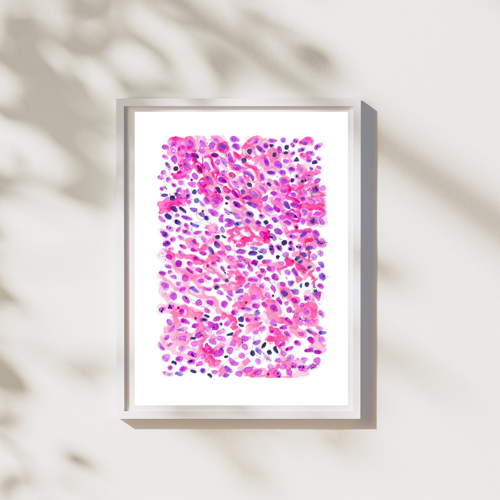 Lung Small Cell Carcinoma Pathology Art Print