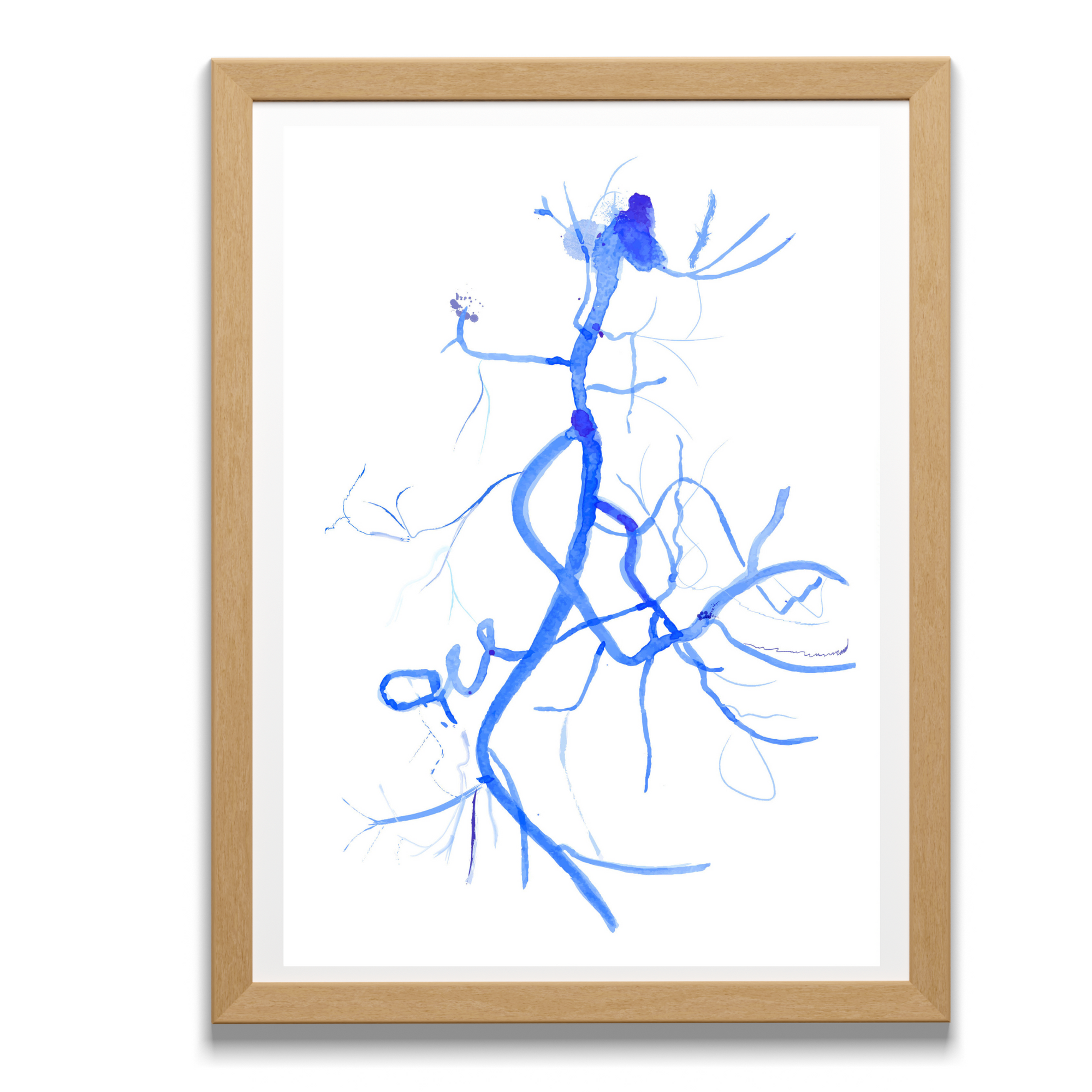 Radiology Art - DSA Internal Iliac Artery, Uterine Artery