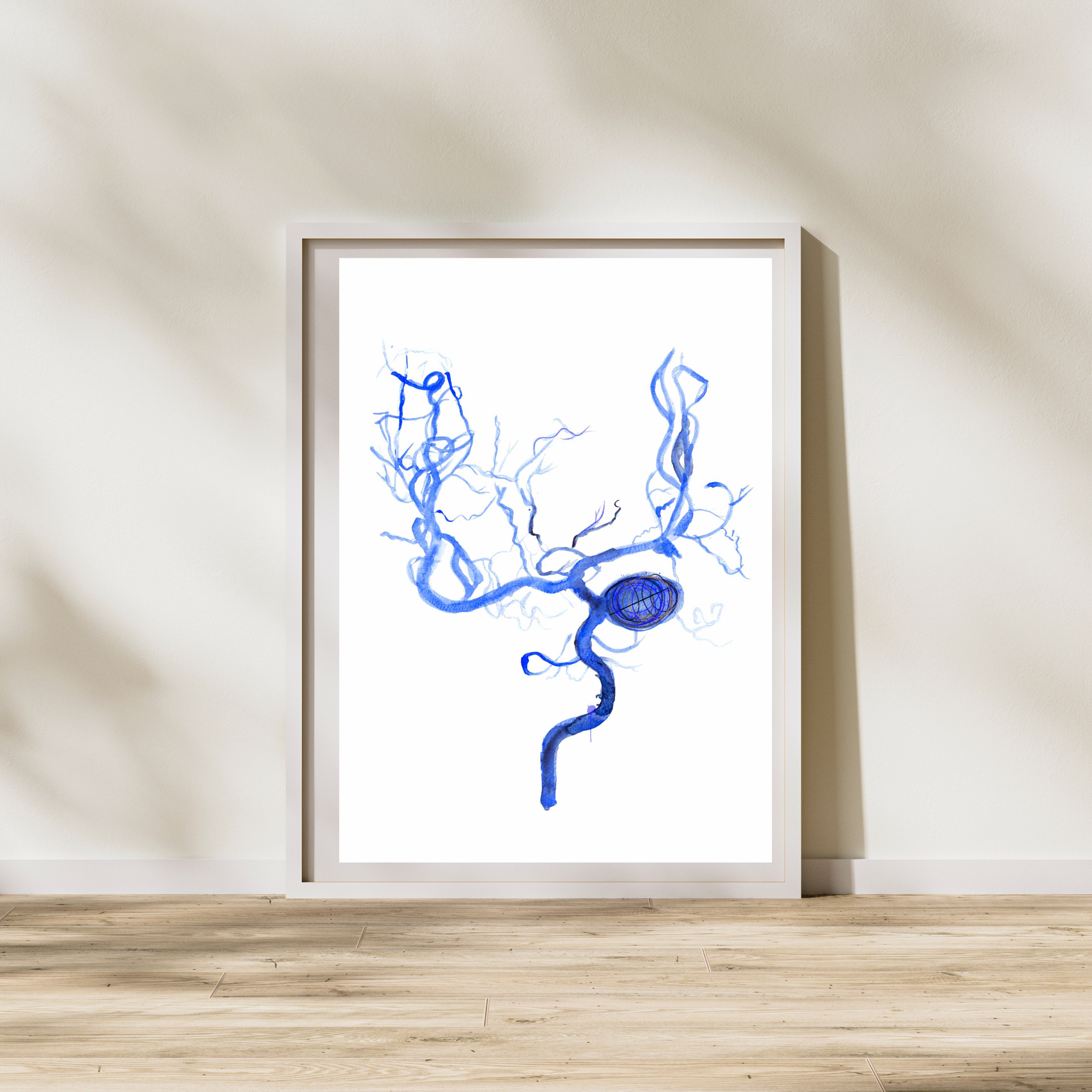 Brain Aneurysm Coiling Art Print