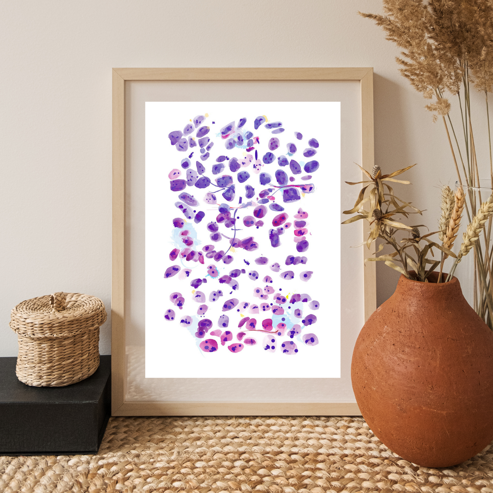 Prostate Adenocarcinoma, metastatic. Abstract Pathology Artwork, Histopathologist Gift