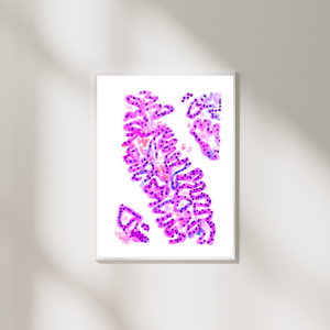 Urothelial Carcinoma Pathology Art