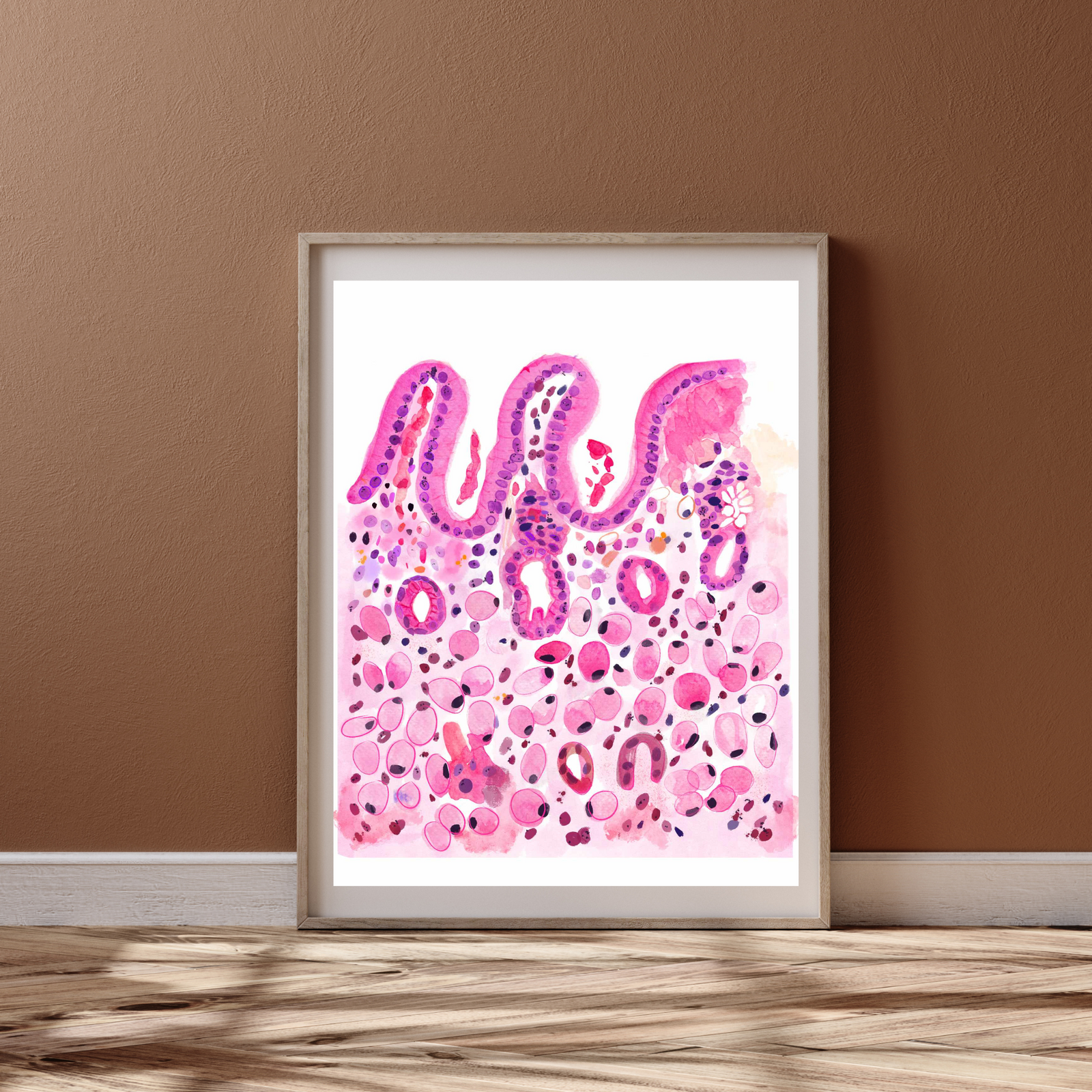 Stomach Signet Ring Carcinoma Histopathology Art