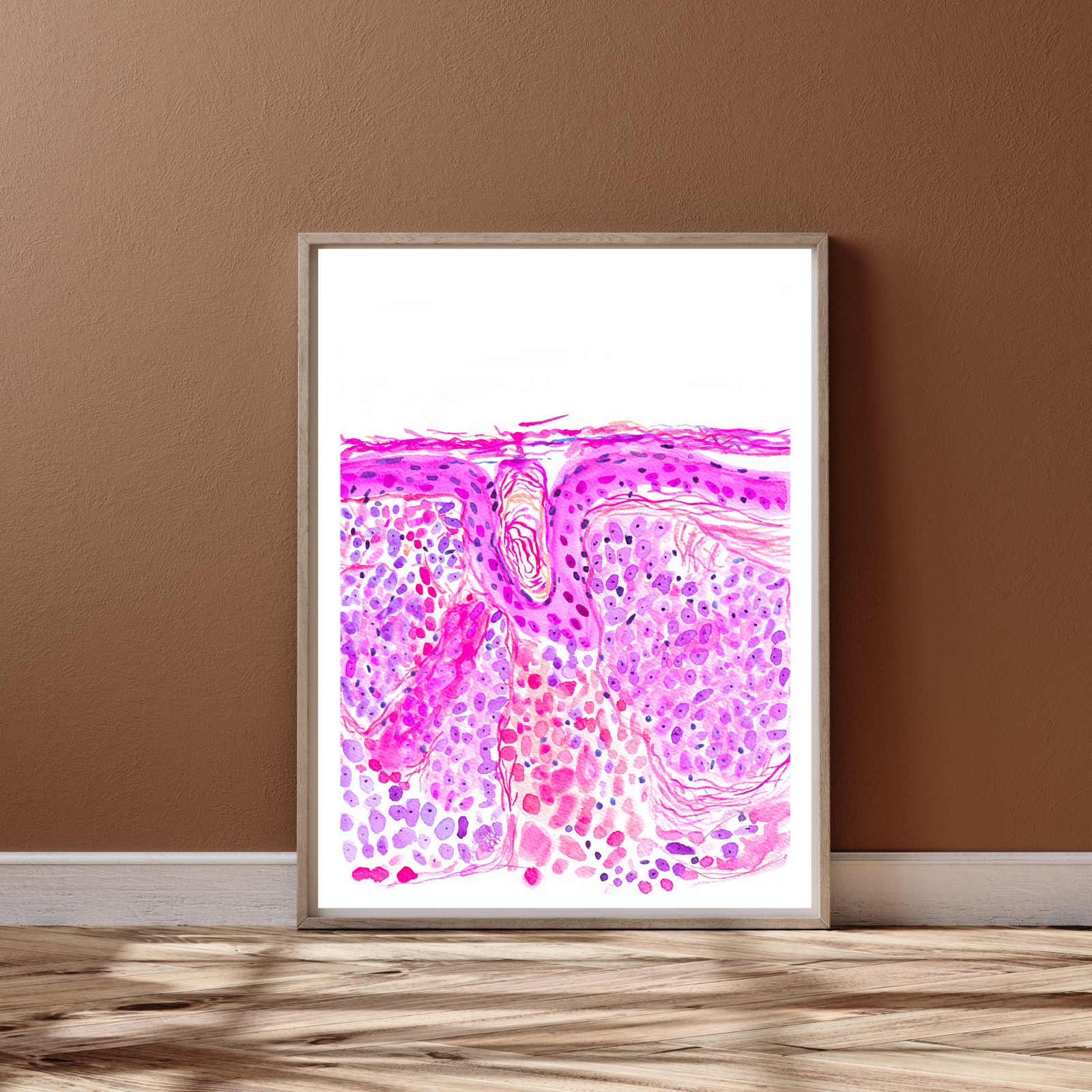 Basal Cell Carcinoma Skin Histopathology Artwork