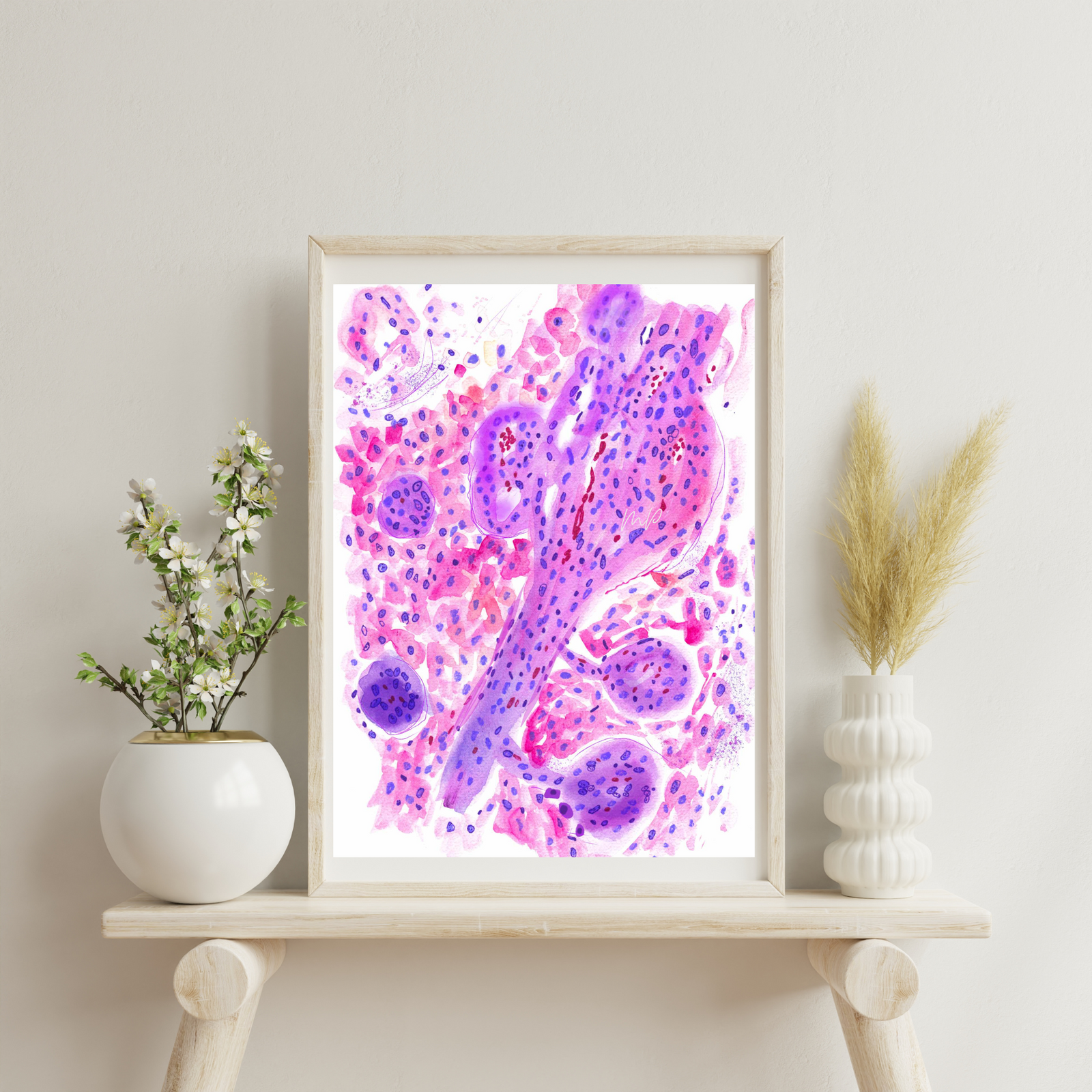 Glioblastoma Neuropathology Watercolor Art Print