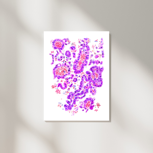 Lung Papillary Adenocarcinoma Pathology Art Print