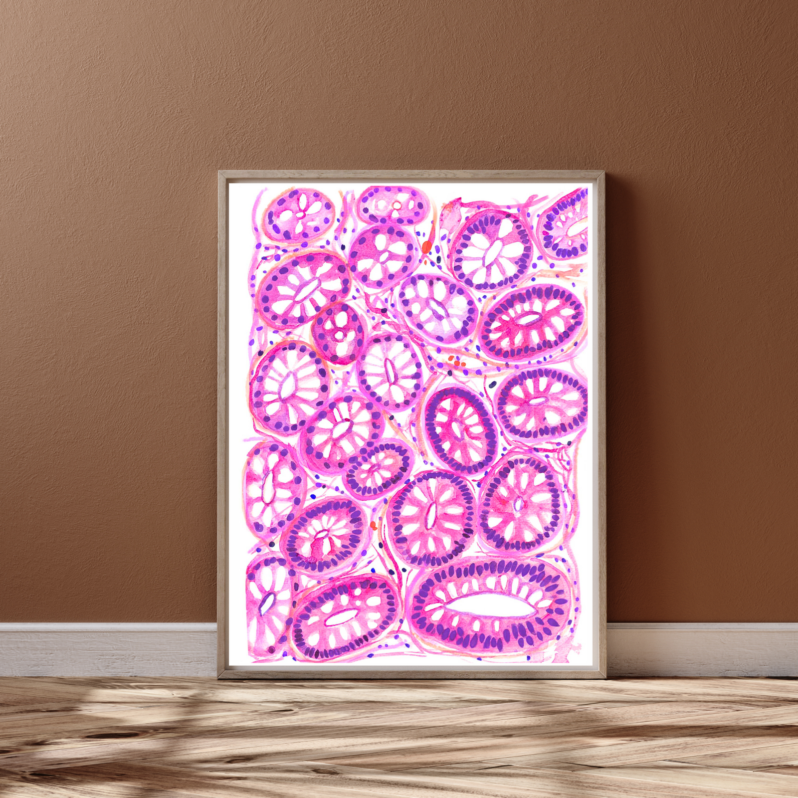 Colon Polyp - Tubular Adenoma Histopathology Art