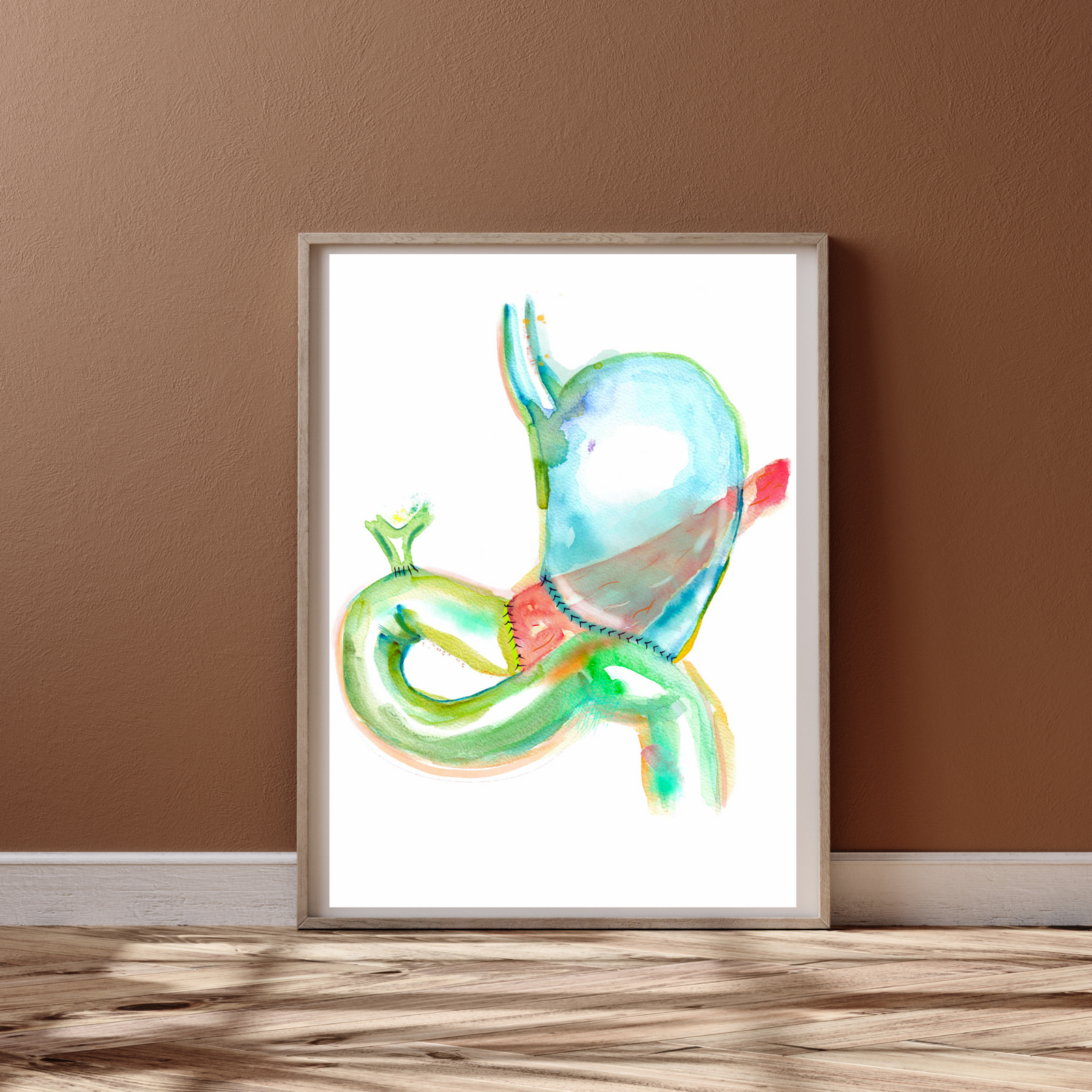 Pancreaticoduodenectomy - Whipple Procedure Art