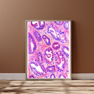 Ovarian Cancer Histopathology Art