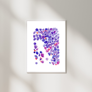 Acute Myeloid Leukemia Art Print