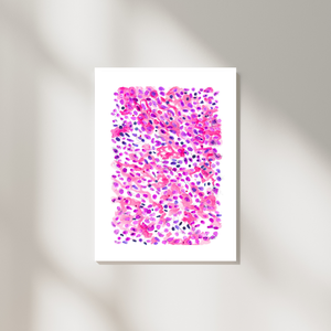 Lung Small Cell Carcinoma Pathology Art Print