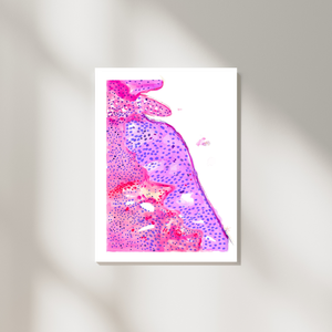 Oropharyngeal Squamous Cell Carcinoma Pathology Art