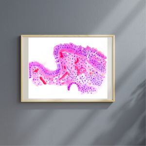 Barrett´s Esophagus Histopathology Art Print