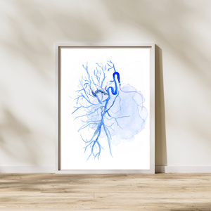 Bronchial Artery Embolization Interventional Radiology Art Print