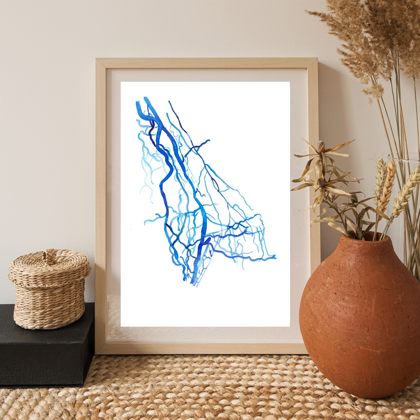 Upper Limb DSA, Vascular Surgery Radiology Art Print