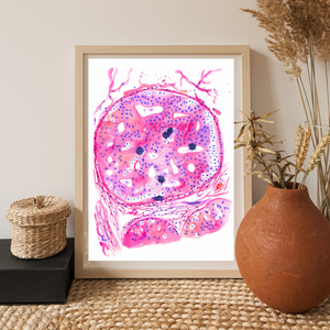 Breast Cancer Histopathology Art - DCIS
