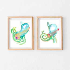 Pancreaticoduodenectomy - Whipple Procedure Art Before and After