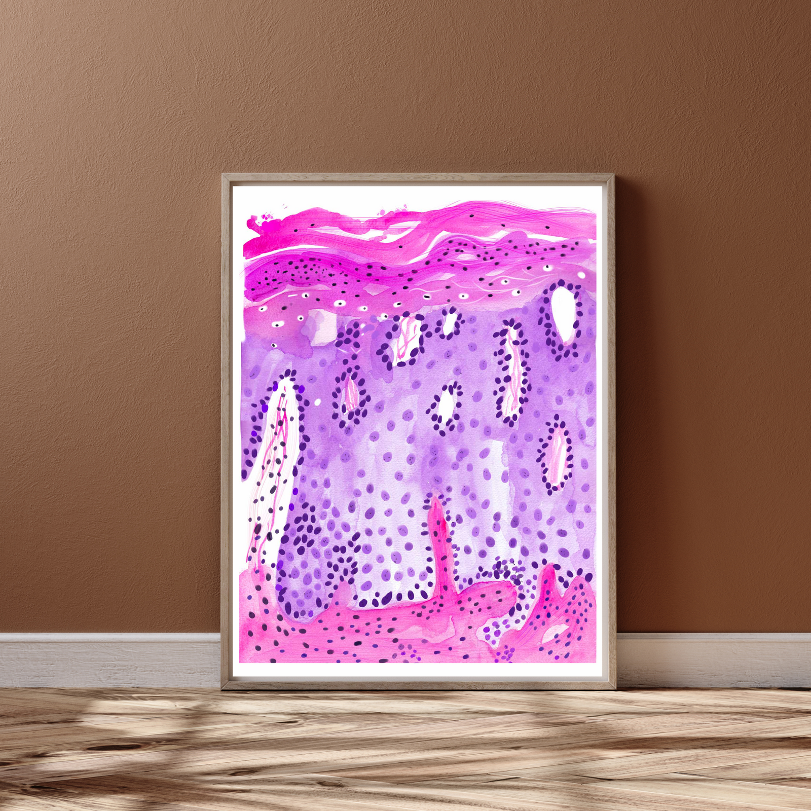 Psoriasis Skin Histopathology Art Print