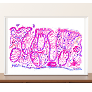 Crohn´s Disease Histopathology Art Print