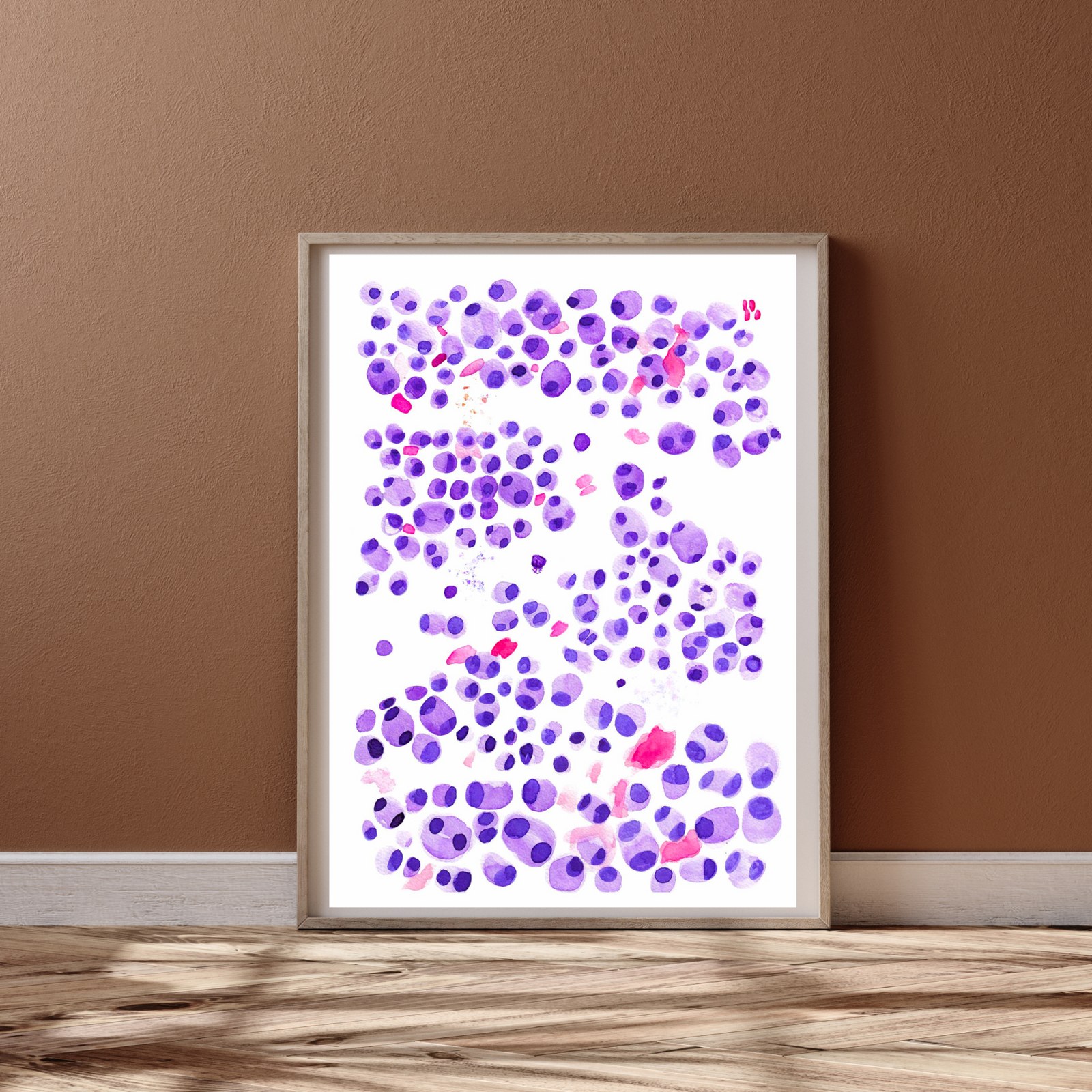 Multiple Myeloma Hematopathology Art