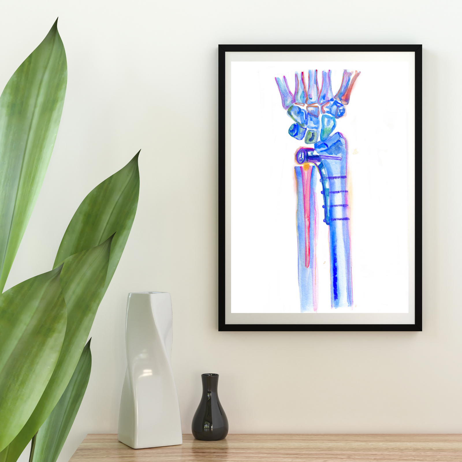 Radioulnar Joint Repair Orthopedic Art