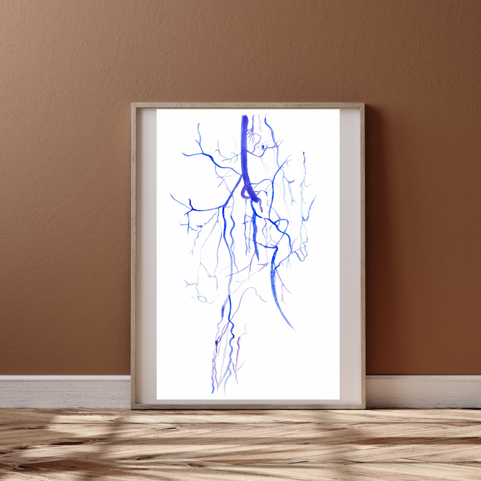 Buerger Disease - Thromboangiitis Obliterans CT Angio