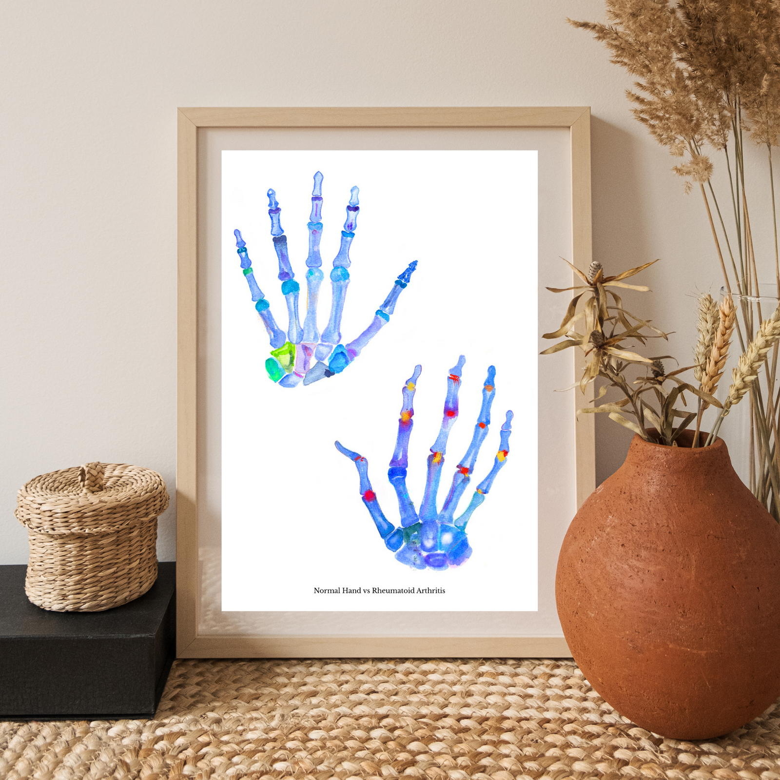 Rheumatoid Arthritis Hand Art
