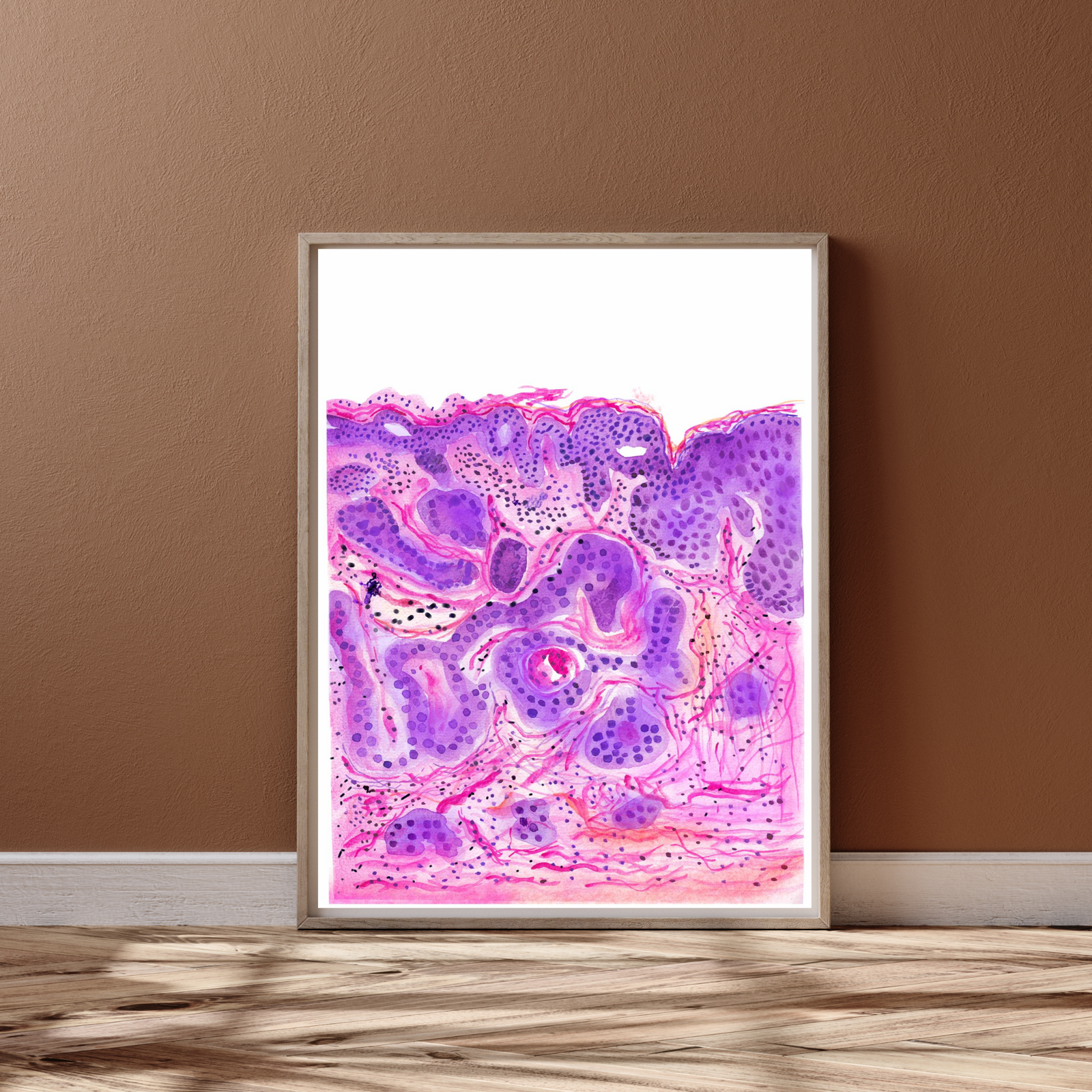 Vulvar Carcinoma Gynecological Pathology Art Print