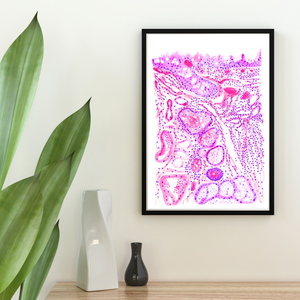 Chronic Conjunctivitis Histopathology Art Print