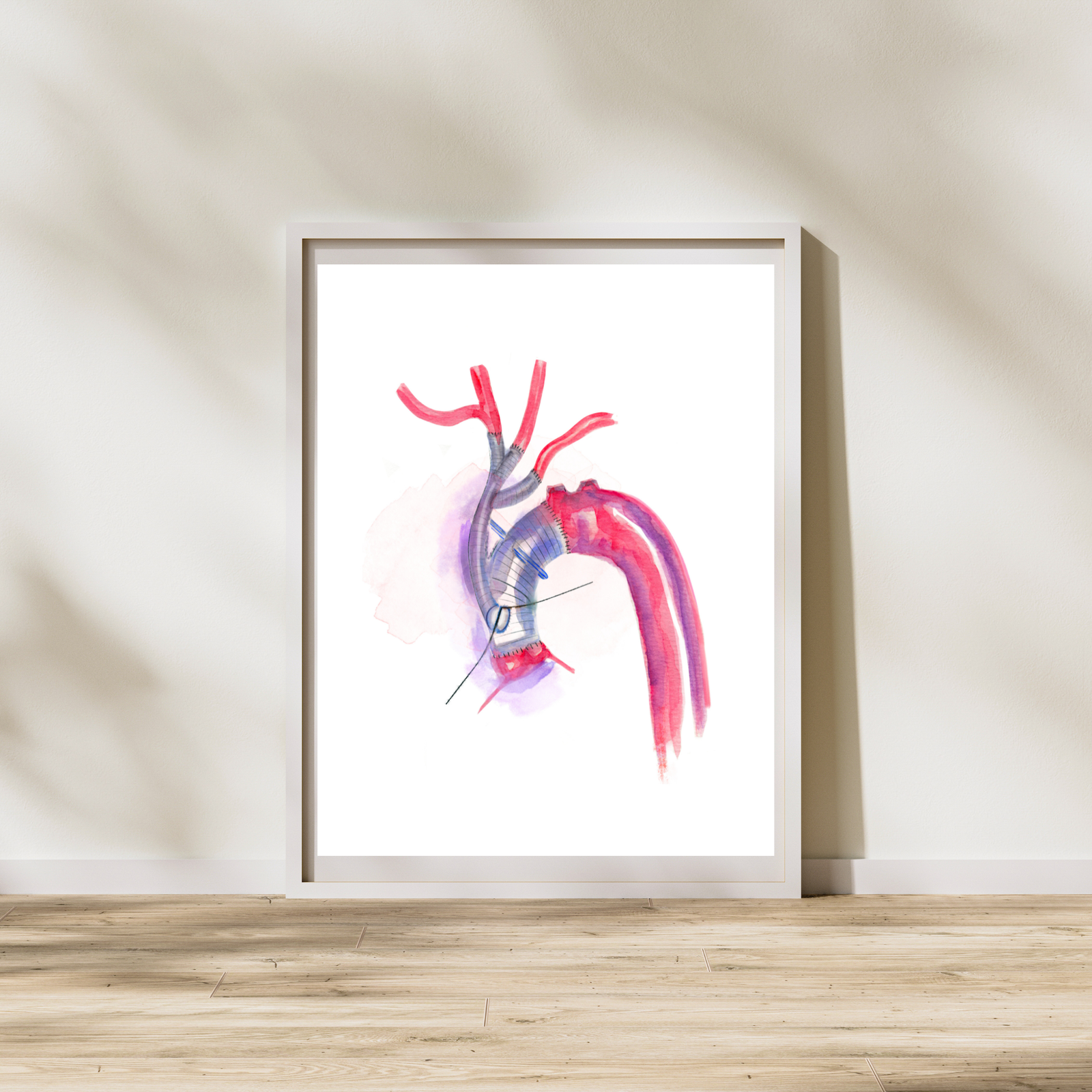 Aorta Aneurysm Repair Art Print