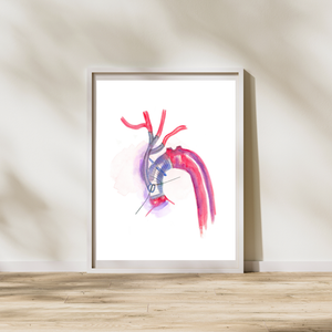 Aorta Aneurysm Repair Art Print