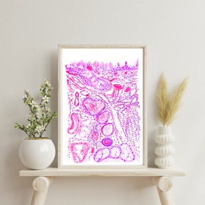 Chronic Conjunctivitis Histopathology Art Print