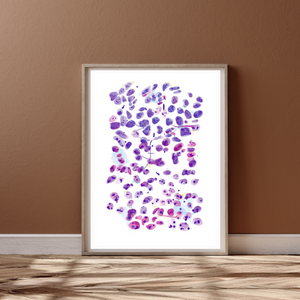 Prostate Adenocarcinoma, metastatic. Abstract Pathology Artwork, Histopathologist Gift