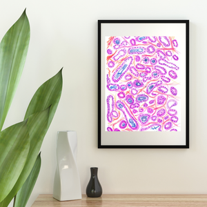 Prostate Adenocarcinoma Uropathology Art Print