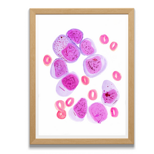 AML Bone Marrow Hisopathology Art