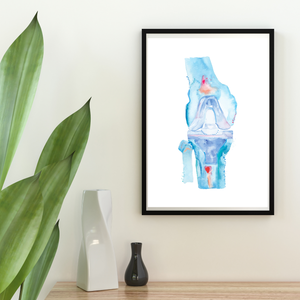 Knee Replacement Surgery Art Print, Orthopedic Surgery Wall Art