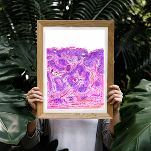 Vulvar Carcinoma Gynecological Pathology Art Print